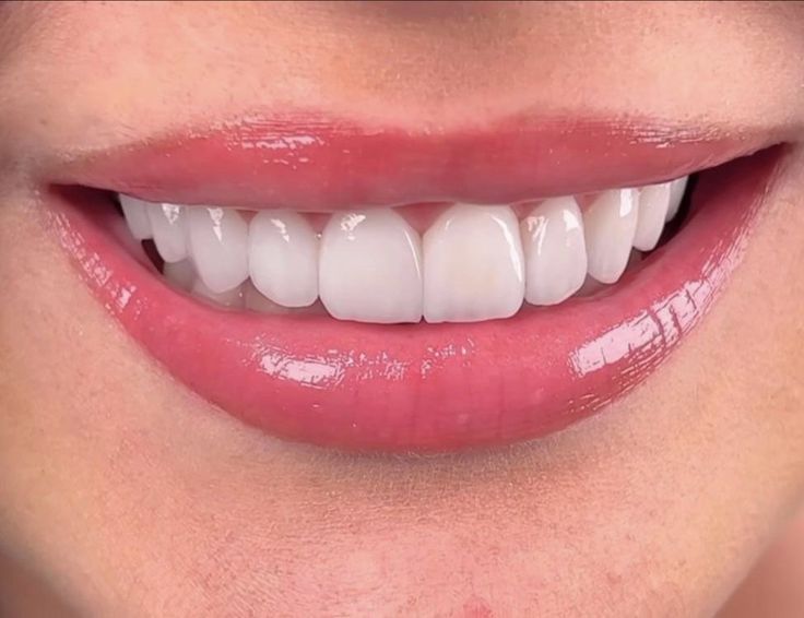 Bordes Incisales