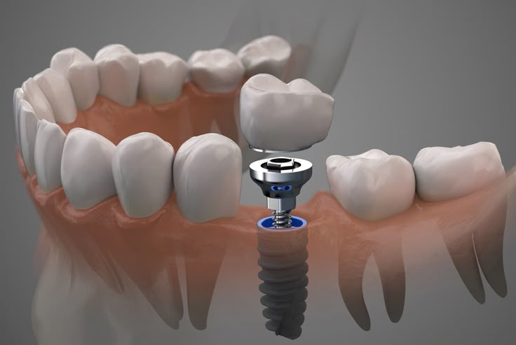 Prótesis e Implantes
